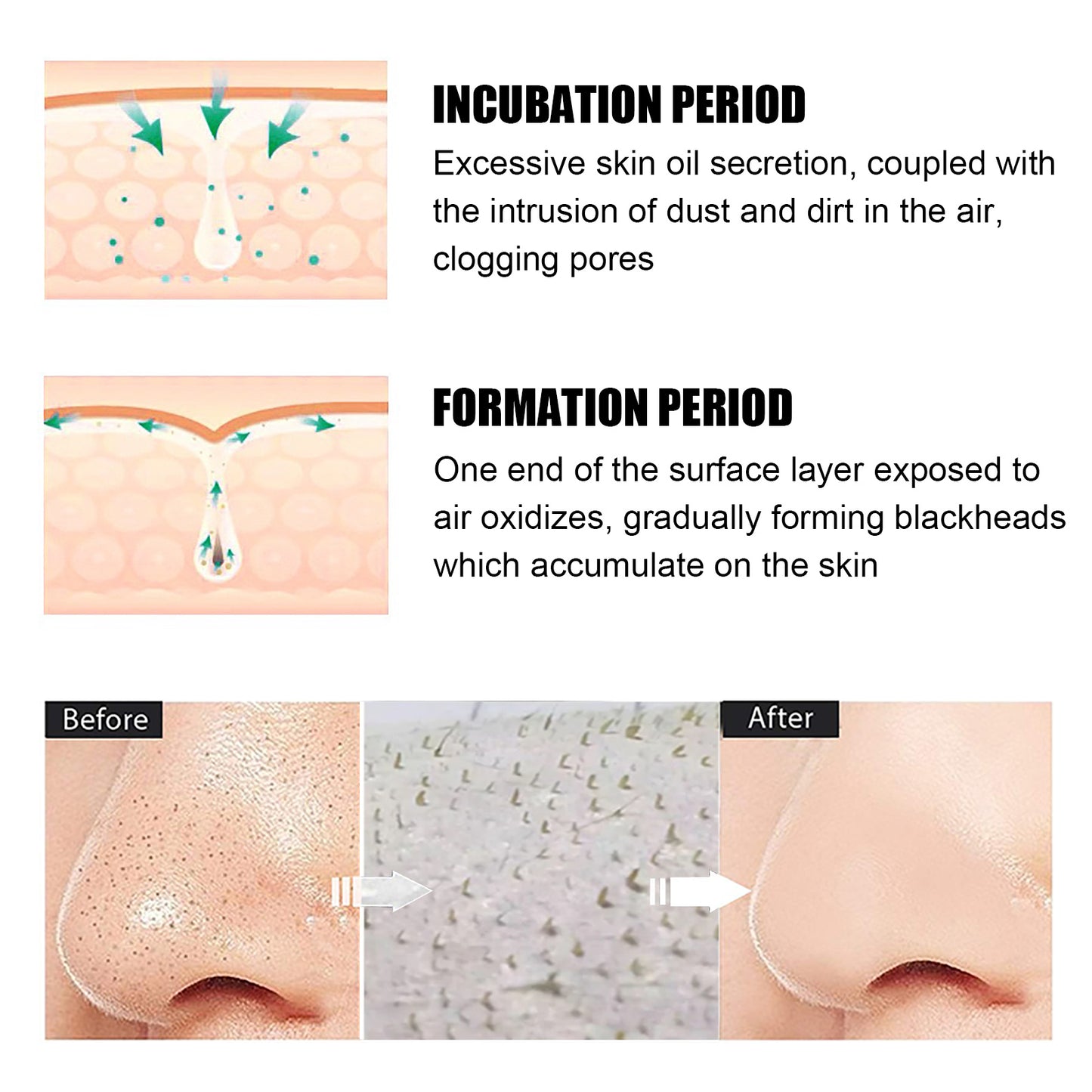 EELHOE ClearSkin™ Blackhead Remover Kit – Detox, Refine, Reveal Radiance - WildSteam Wellness