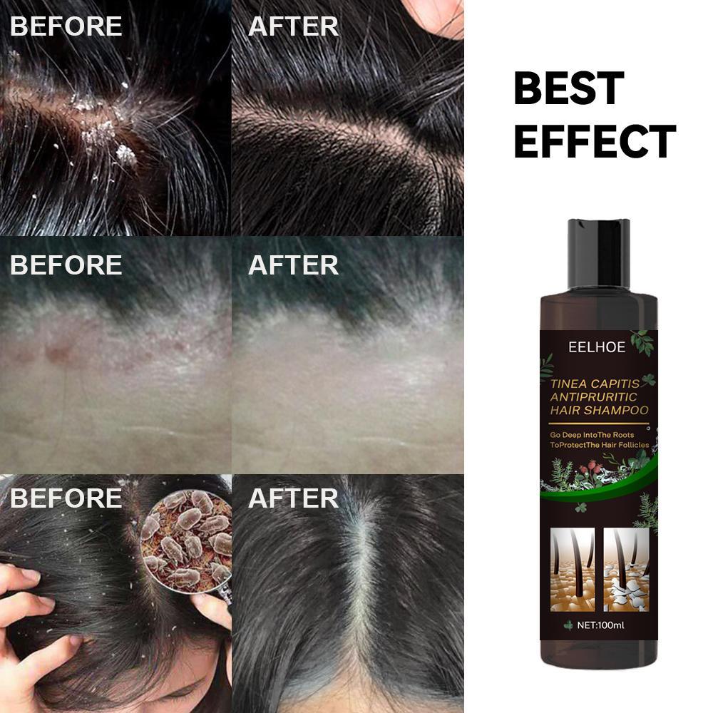 EELHOE™ Anti-Dandruff Shampoo – Soothe, Cleanse & Strengthen Naturally - WildSteam Wellness