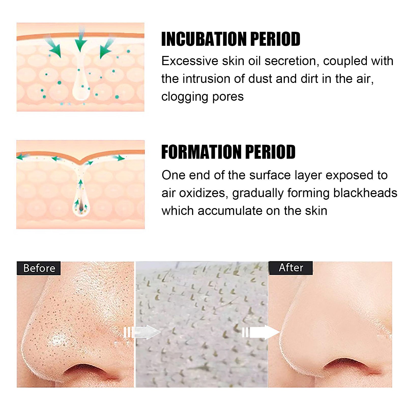 EELHOE ClearSkin™ Blackhead Remover Kit – Detox, Refine, Reveal Radiance - WildSteam Wellness